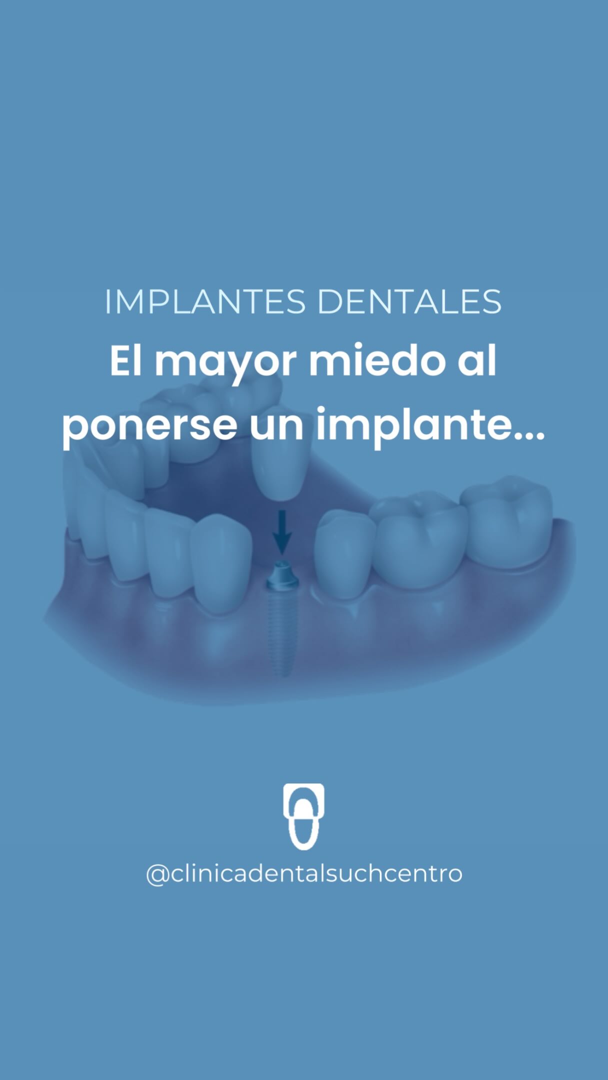 Clínica dental en Valencia: 66 Implantes dentales
·
#clinicadentalvalencia #implantesdentales #such